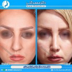 جراحی بینی 1-4